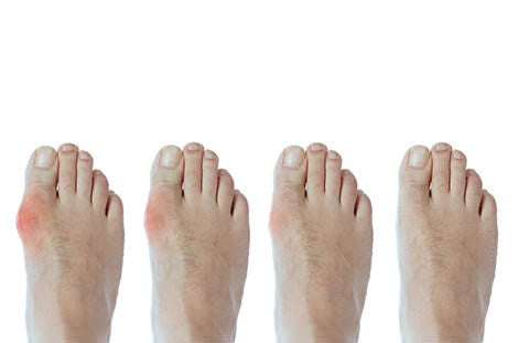 Rheumatology of the Foot